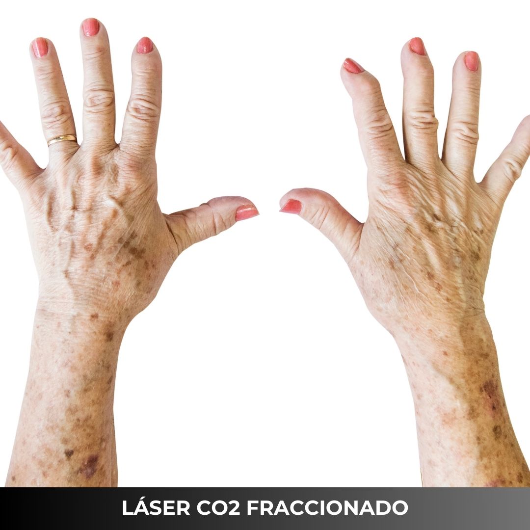 ELIMINACION DE MANCHAS