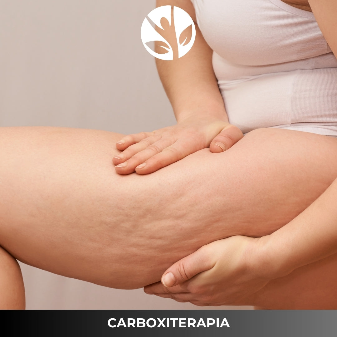 CARBOXITERAPIA