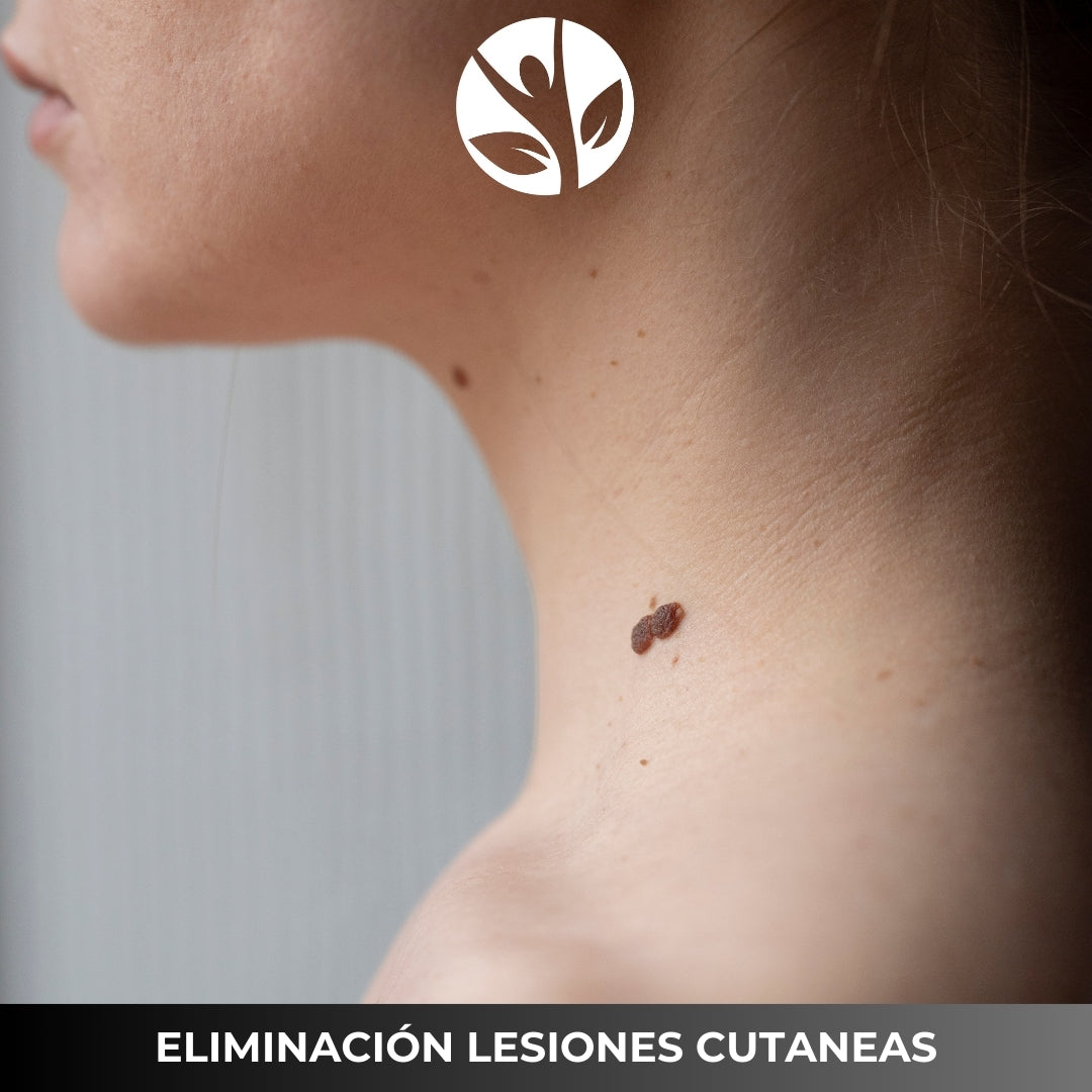 ELIMINACION DE LESIONES CUTÁNEAS