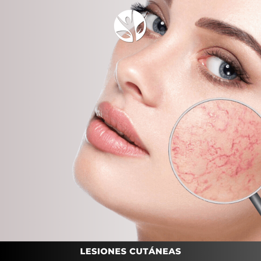 LESIONES VASCULARES