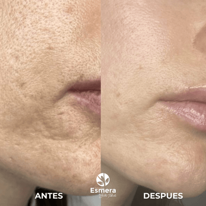MARCAS DE ACNÉ – CLINICA ESMERA