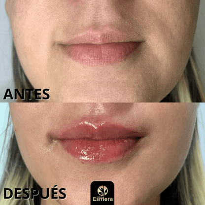 AUMENTO DE LABIOS