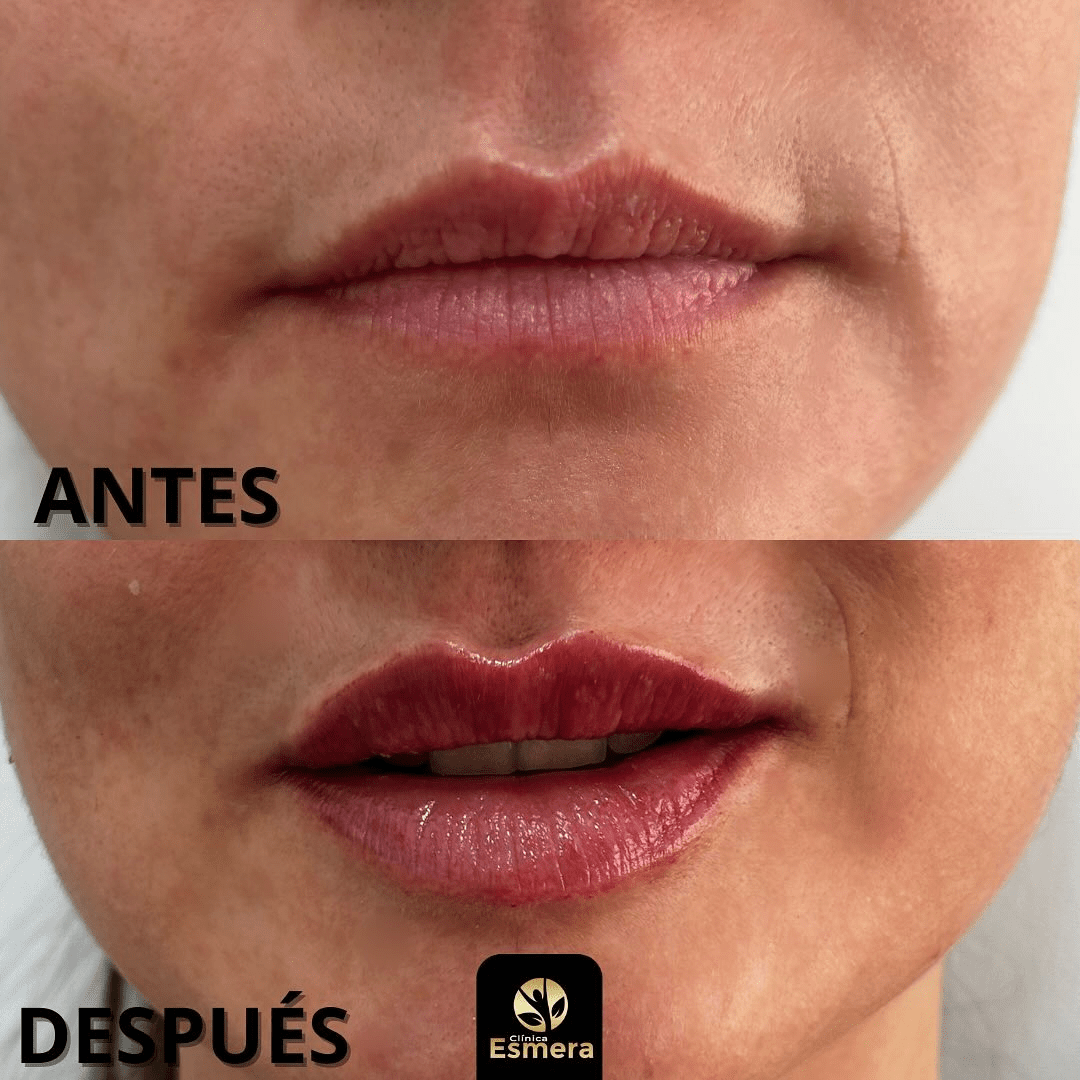 AUMENTO DE LABIOS