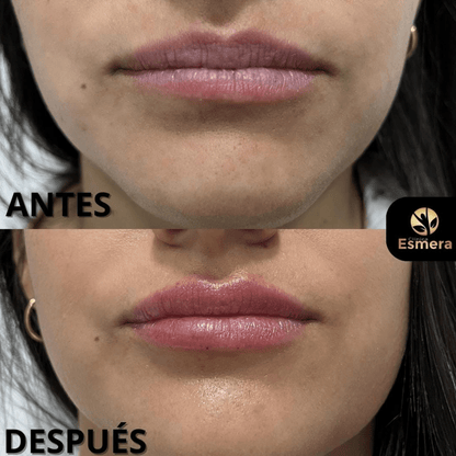 AUMENTO DE LABIOS