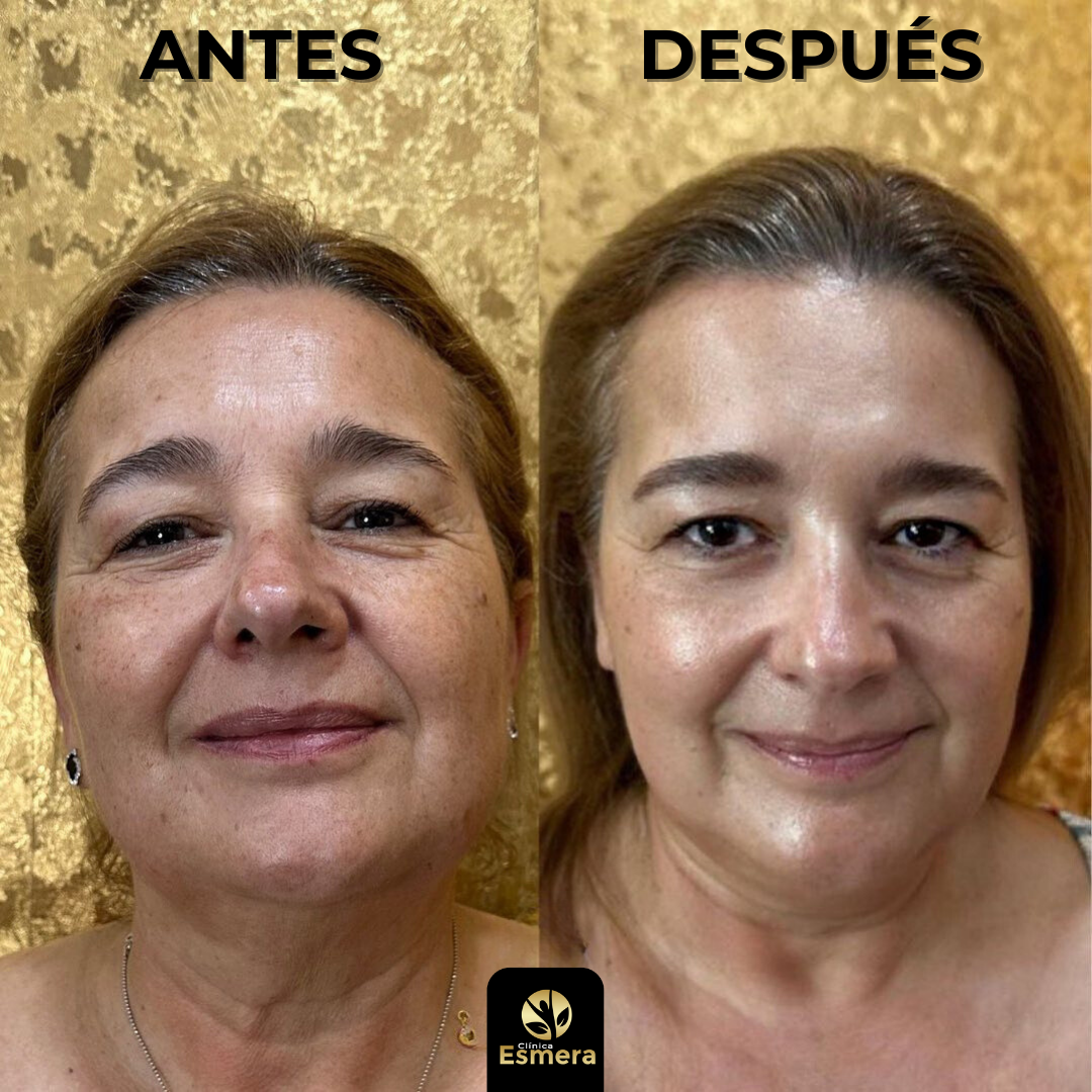 Peeling facial láser precio sale